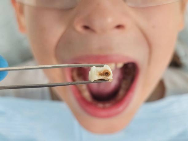 Best Emergency Tooth Extraction in Norwich, CT