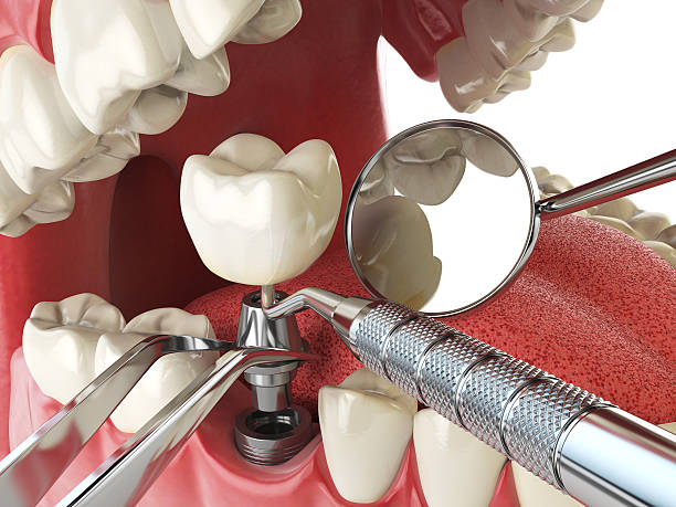 Best Emergency Root Canal Treatment in Norwich, CT